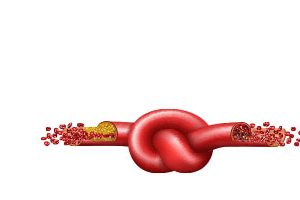 BLOOD CLOTS